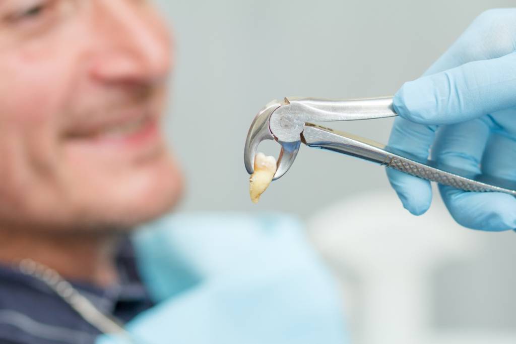 extraction de dents comparateur mutuelle dentaire